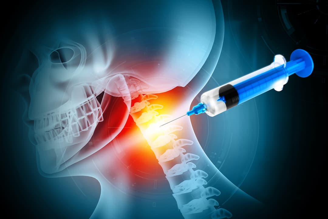 is foraminal stenosis a disability