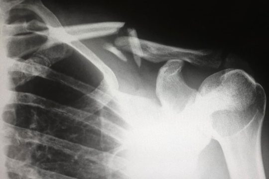Tampa Personal Injury Lawyer