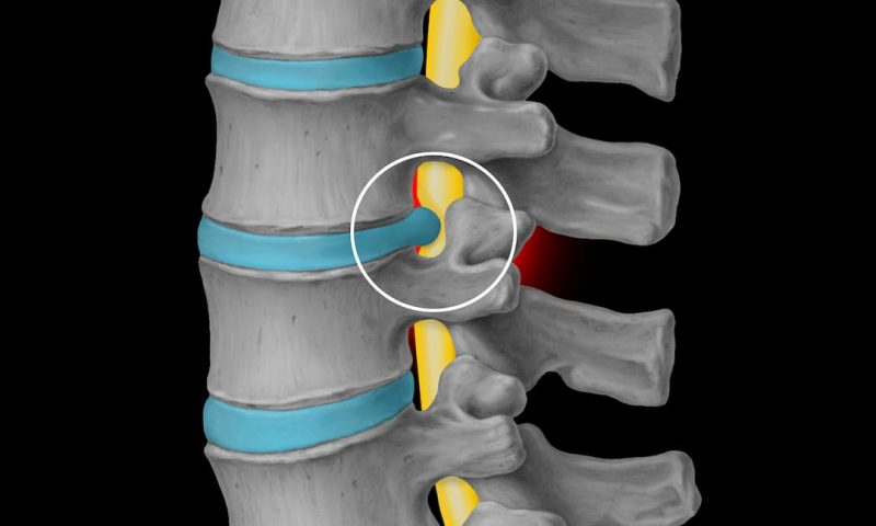 porcentaje de incapacidad por hernia de disco l5-s1